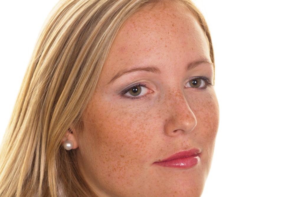 Balancing an Uneven Skin Tone - OZNaturals